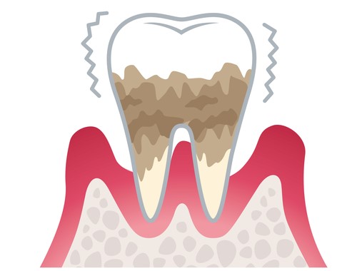 重度歯周炎