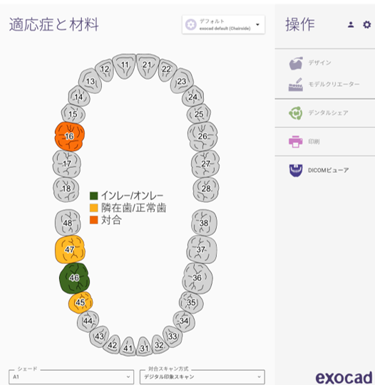 ②	デジタルデータをもとに詰め物の設計2