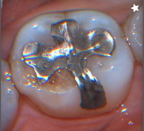 ①	銀歯の下にむし歯が再発1