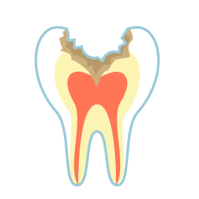 C3：神経のむし歯