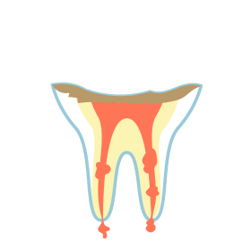 C4：歯根のむし歯